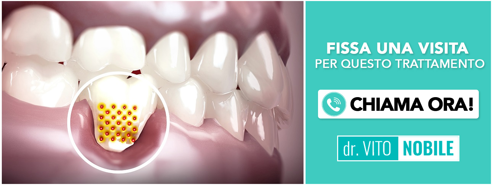 ricostruzione-delle-gengive Taranto